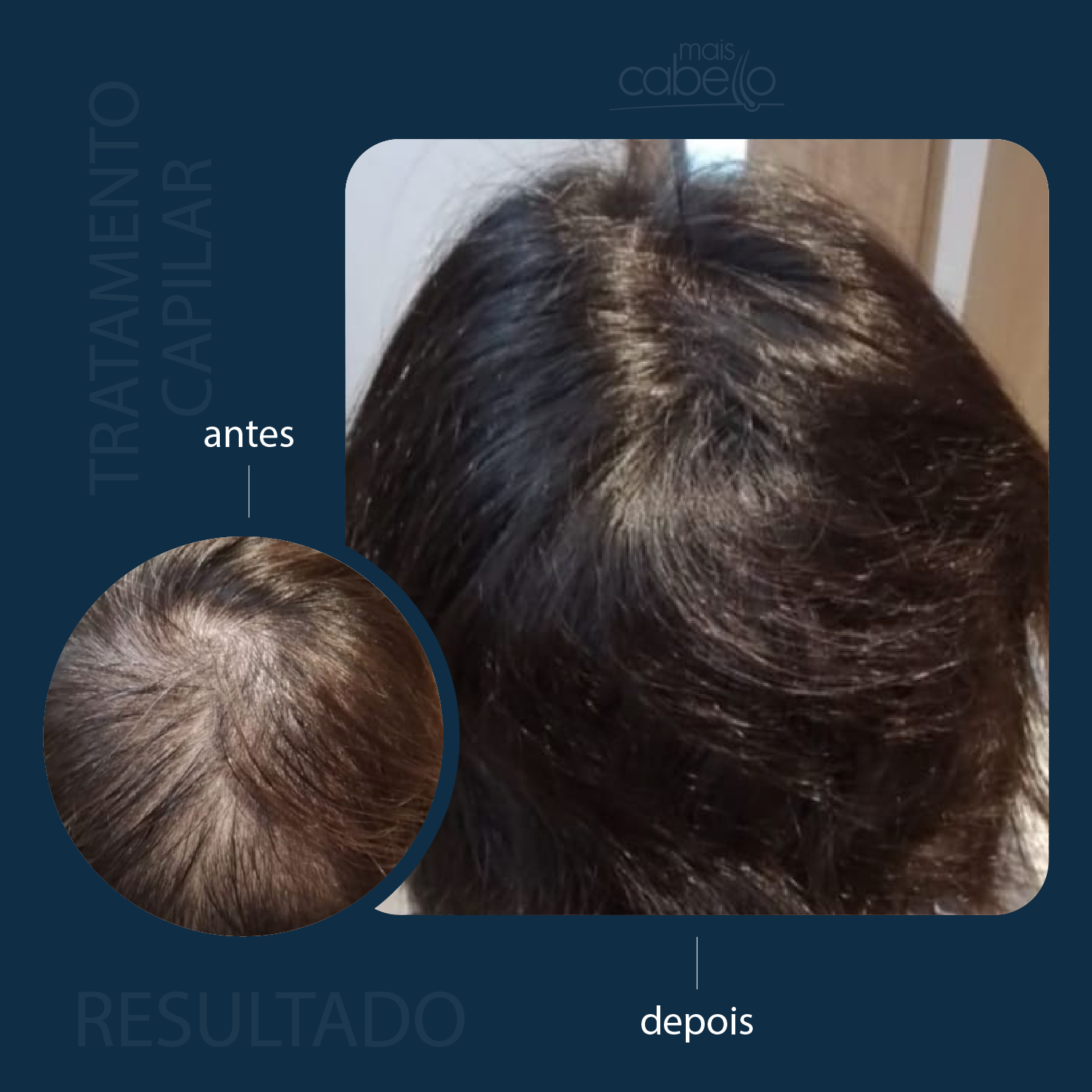 Antes e Depois - Rarefação Feminina
